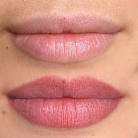 lip neutralization
